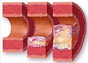 Development stages of atherosclerotic plaque in a vessel with hypertension